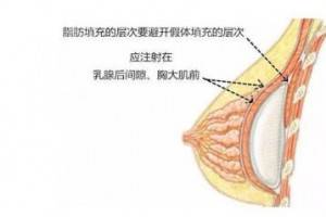 自体脂肪丰胸后护理很重要，要注意6个细节的护理