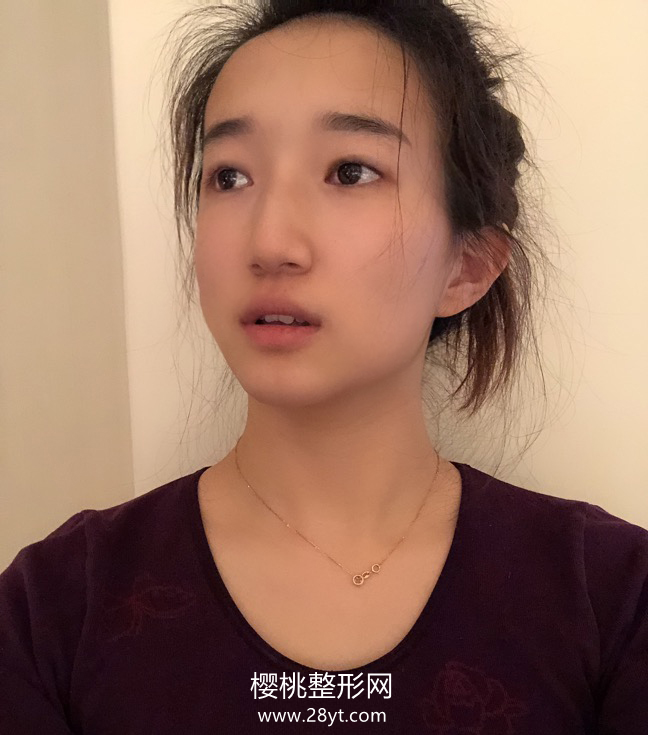 石家庄美莱李锦卓割双眼皮技术怎样？案例+价格表一览