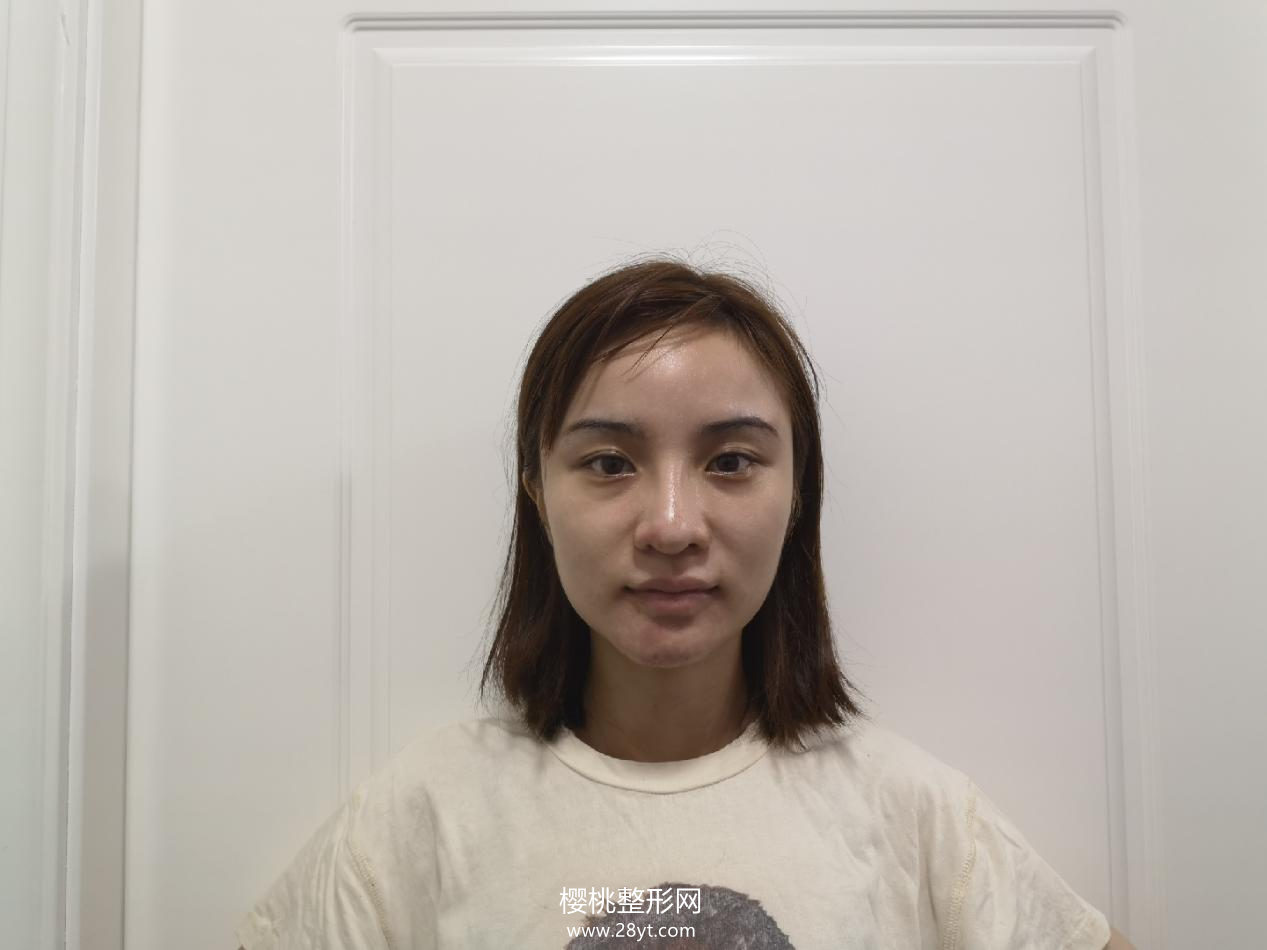 南宁连美刘泳铖隆鼻真人案例+最新隆鼻价格一览