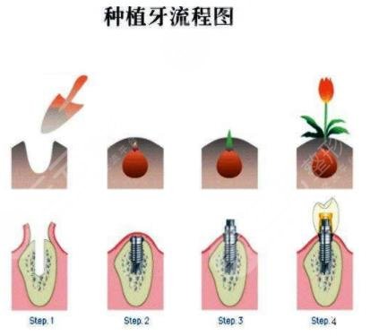 种植牙流程