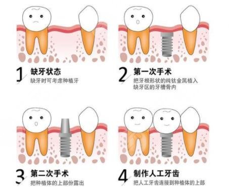 种植牙术前注意事项