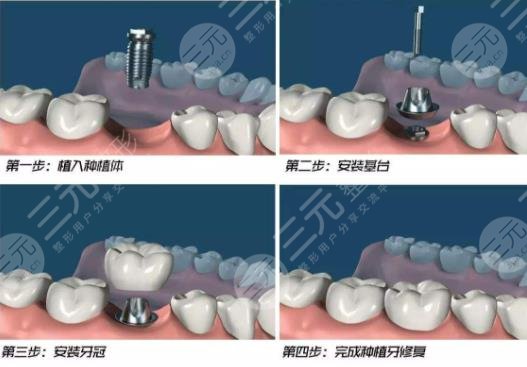 种植牙步骤