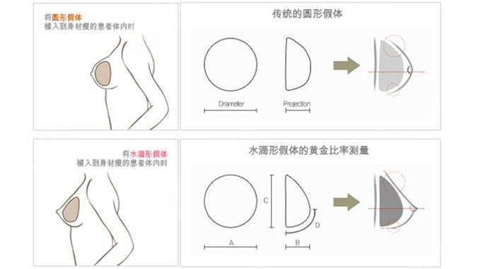 假体隆胸手术需要几个小时