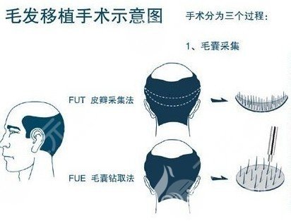 无痕植发价格大概是多少钱?