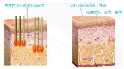 热玛吉的一次性费用是多少呢?