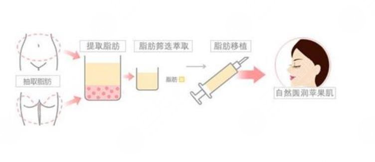 苹果肌下垂提升的好方法超全盘点?自体脂肪填充