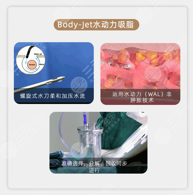 水动力吸脂