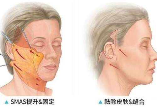 电波拉皮的功效与作用是什么？注意事项分享，想知道的均在这！