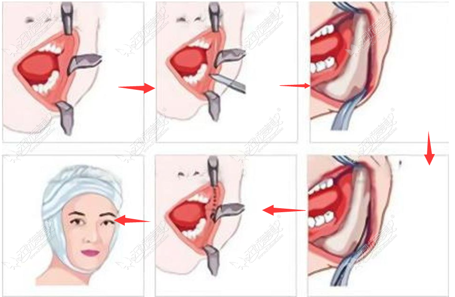 下颌角手术切口在哪儿——内切口