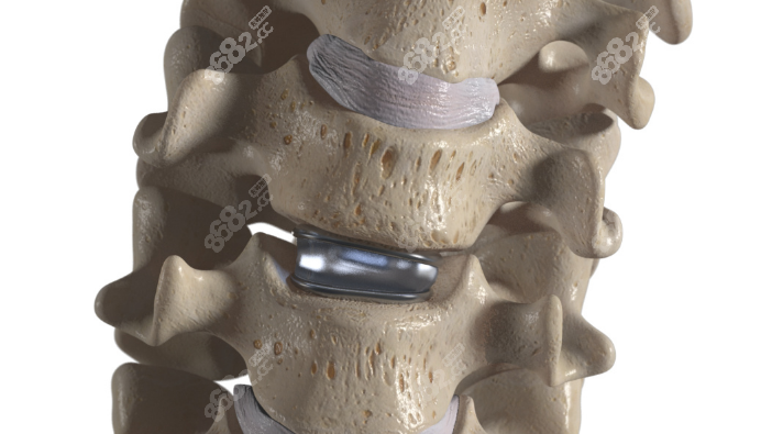 颈椎人工椎间盘置换术费用