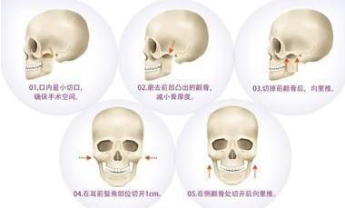 为什么有人做完颧骨手术后悔死了？真相大公开