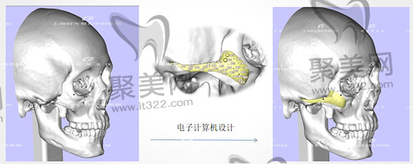 上海时光何晋龙颧骨颧弓修复手术