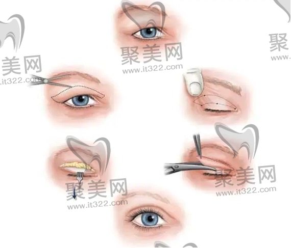 双眼皮修复过程