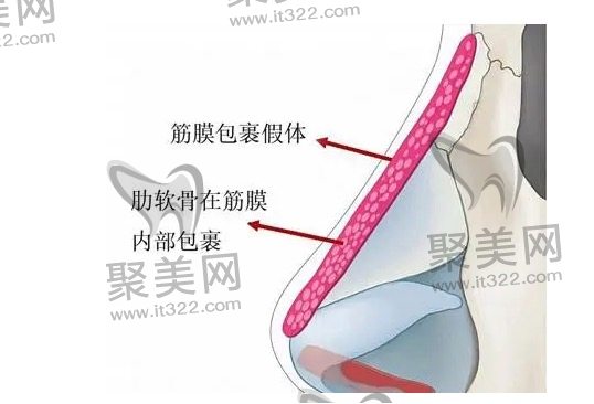 肋骨隆鼻