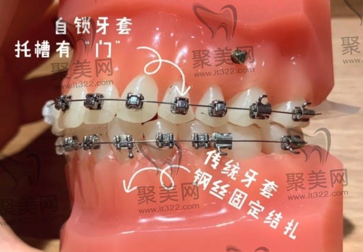 不同类型牙齿矫正方式的区别