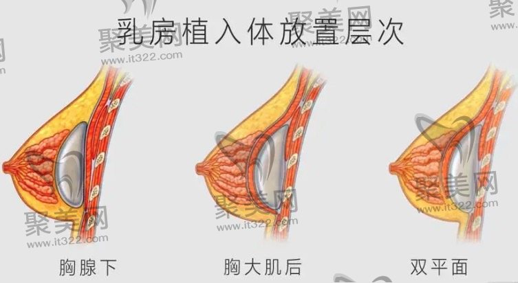 乳房放置假体的位置