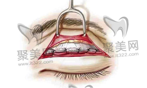双眼皮修复