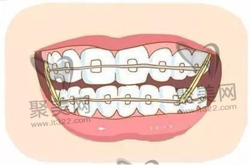 牙齿正畸