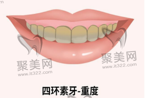 重度四环素牙