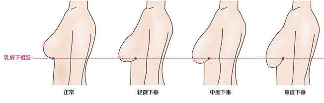 乳房下垂应该怎么办？