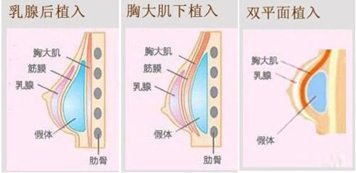 假体隆胸是*的吗？假体隆胸多少钱？需要取