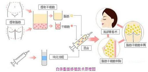 自体脂肪填充容易被吸收、移位吗？