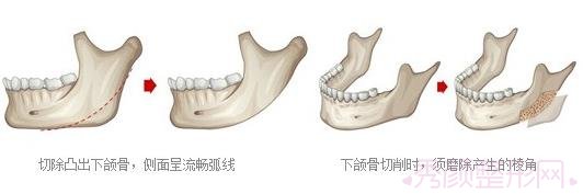 上海九院余东做磨骨术怎么样？多少钱？