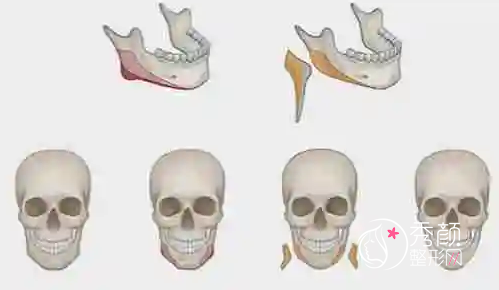 磨骨手术（颧骨下颌角）失败了怎么办？该怎么修复？