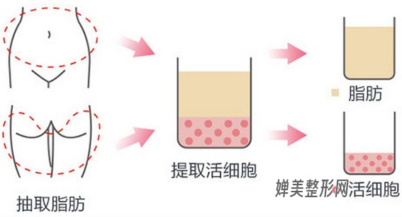 自体脂肪能填充哪些部位？自体脂肪填充效果好不好？