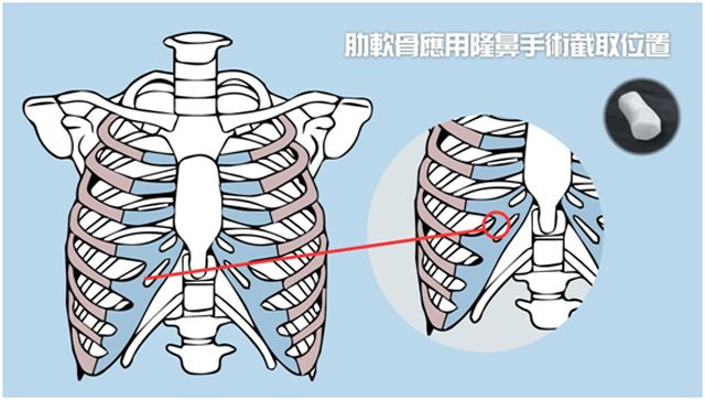 干货科普|自体软骨隆鼻到底好不好？