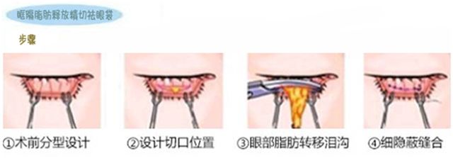 有了显老眼袋和泪沟，该怎么解决?