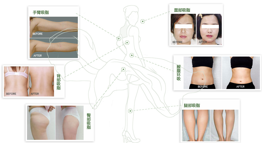 3D水动力环形吸脂适合哪些人