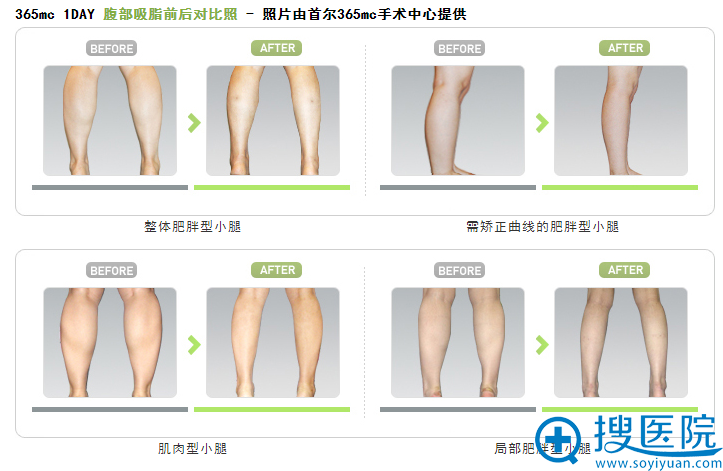 韩国首尔365mc医院小腿吸脂前后对比案例