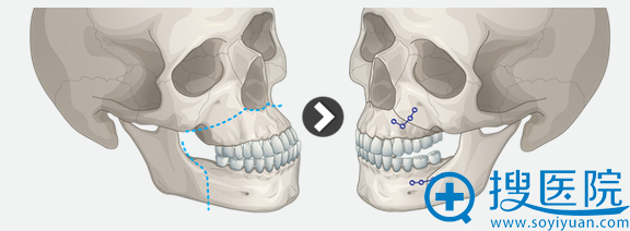 韩国ID整形医院双鄂手术方法
