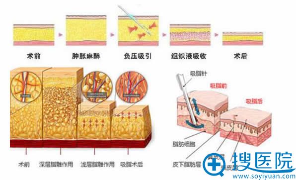 北京雅韵整形去除副乳的手术