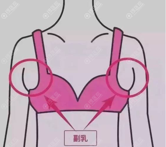 副乳不治疗会有什么影响？