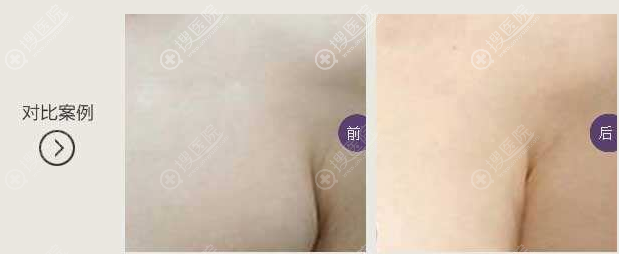 去除副乳前后对比效果