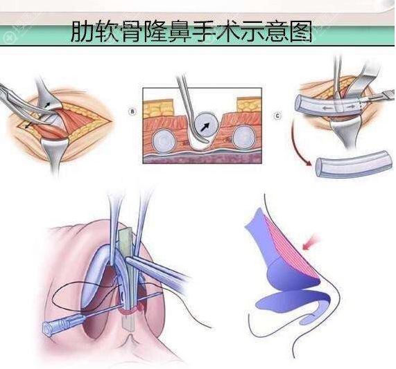 肋软骨隆鼻示意图