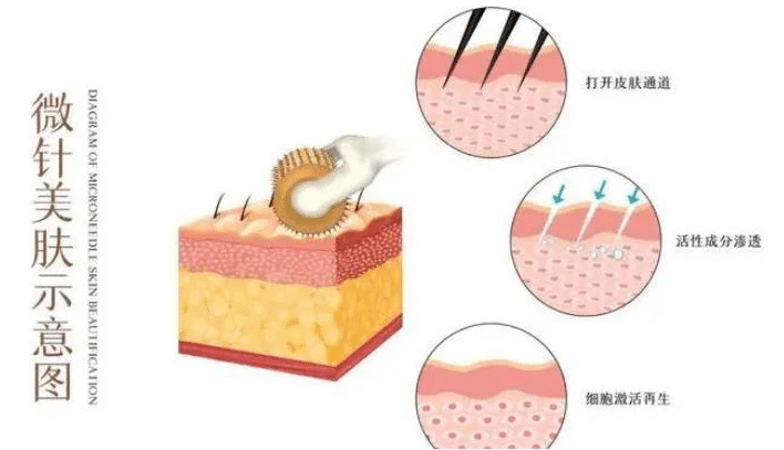 微针祛痘印的原理是什么，有什么优势